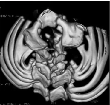Figure 9 - A 3 D reconstruction CT scan of the lumbar spine in a 15-year-old boy showed a unilateral, posterior unsegmented bar including the upper three lumbar vertebrae associated with fusion of the corresponding spinous processes.