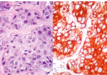 Figure 2 - A high-grade invasive ductal carcinoma with numerous mitotic figures (A) and EGFR immunoexpression (B).