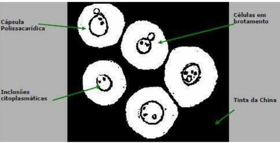 Fig. 4:  Cryptococcus    sp :    leveduras    em    brotamento rodeadas    de halo transparente (cápsula    polissacarídica), sobre fundo negro formado pela tinta nanquim