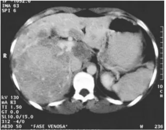 Figure 1 - Contrast-enhanced CT-scan showing multiple hypervas- hypervas-cularized hepatic nodules, consistent with the diagnosis of LA.