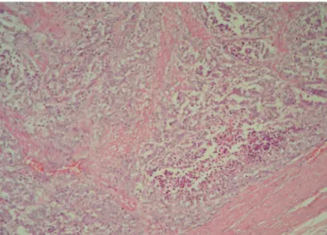 Figure 3 - Anal melanoma. Cross-section of the external surface region (H&amp;E 6 100).