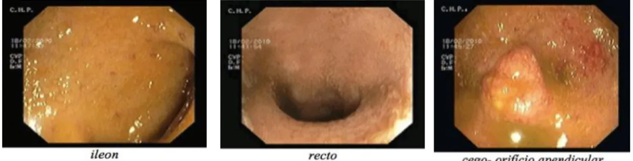 Figura 1: Ileocolonoscopia, Fevereiro de 2010 