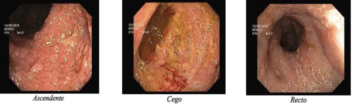 Figura 3: Peça operatória de colectomia total  Figura 2: Ileocolonoscopia, Setembro de 2010 