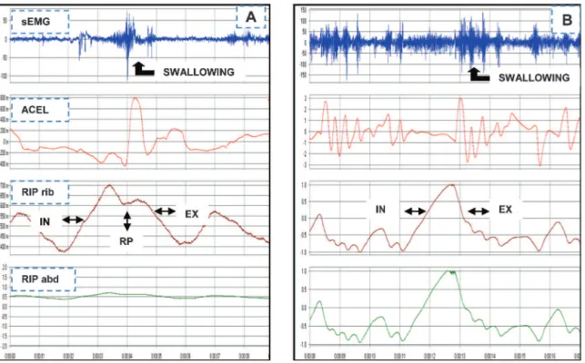 Figure 2 is a graphical illustration of the signal integration of the respiration–swallowing interactions in preliminary study participants during the action of swallowing water.
