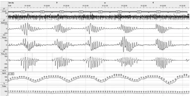 Figure 1 - Polysomnographic recording (5 minutes tracing) of an HCM patient with normal left ejection fraction presenting a Cheyne- Cheyne-Stokes respiration during sleep