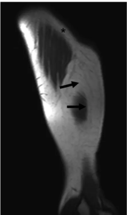 Figure 2 - Sagittal T1 weighted MRI of the left arm shows lipomatous hypertrophy (arrows) at the injection site
