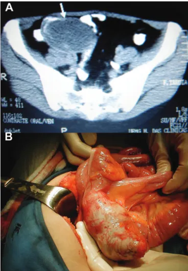 Figure 1 - A) CT scan showing a well-encapsulated cystic mass in the right lower quadrant (arrow); B) Mucocele of the appendix.