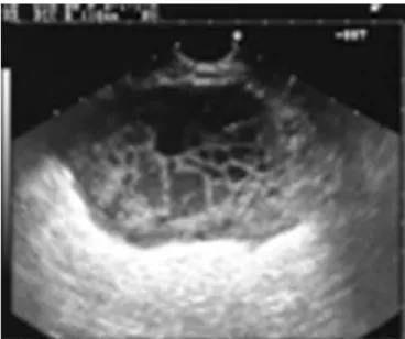 Figure 4 - Computed tomography showing the pigtail catheter left in the gastric wall abscess for drainage.