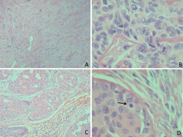 Figure 1 - Eccrine Porocarcinoma – Histology. A. diffuse iniltrative pattern, B. atypical elongated cells and central groove, C