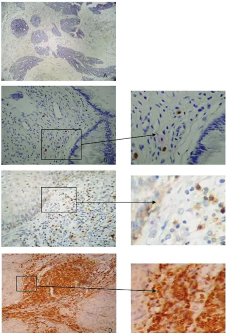 Figure 1 -.Samples of stained tissue sections. Histological analysis of tissue stained by CD3 immunohistochemistry shows positive cells (in brown; B, C  and D) with a score of 0 (A), 1 (B), 2 (C) or 3 (D), as described in the “Materials and Methods” sectio