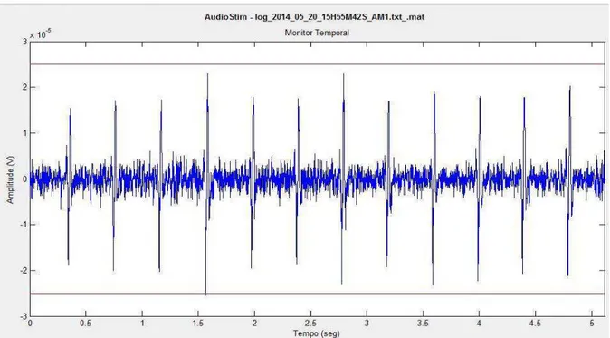 Figura 4: Sinal de EEG coletado em neonatos. Linhas horizontais representam os limiares de rejeição