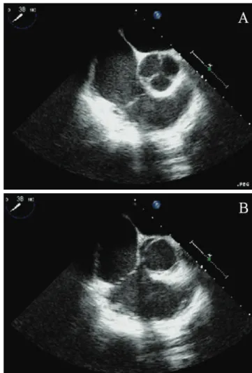 Figure 2 - A short axis view of the aorta, showing the aortic valve. (A) Three  commissures with equal-sized lealets during diastole