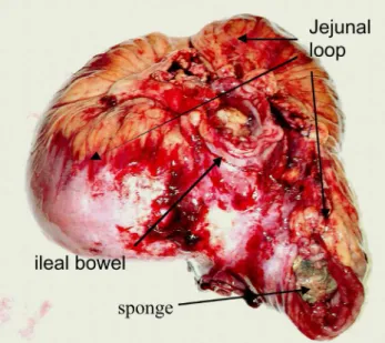Figure 3 - The retained surgical sponge.
