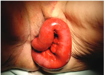 Figure 1 - Pelvic examination revealing the small bowel prolapsing through  the vagina.