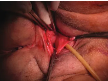 Figure  3  -  The  vaginal  defect  was  closed  by  absorbable  sutures  via  the  vaginal route.