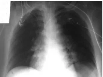Figure  1  -  Control  X-ray  obtained  after  insertion  of  the  central  venous  catheter.