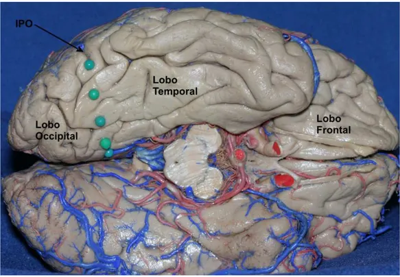 Figura 5. Delimitação do lobo occipital na face basal do hemisfério cerebral. Uma linha (pinos verdes) 