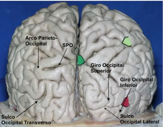 Figura 7. Sulcos e giros do lobo occipital. O sulco occipital lateral é o mais consistente, dividindo o lobo 