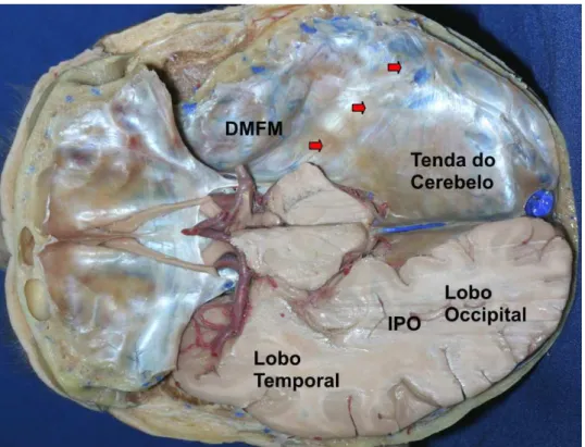 Figura 9. A tenda do cerebelo e suas relações com o lobo occipital. A face basal dos lobos occipitais 