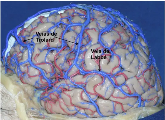 Figura 12. Veias anastomóticas da face lateral do hemisfério cerebral. A veia de Trolard faz parte do 