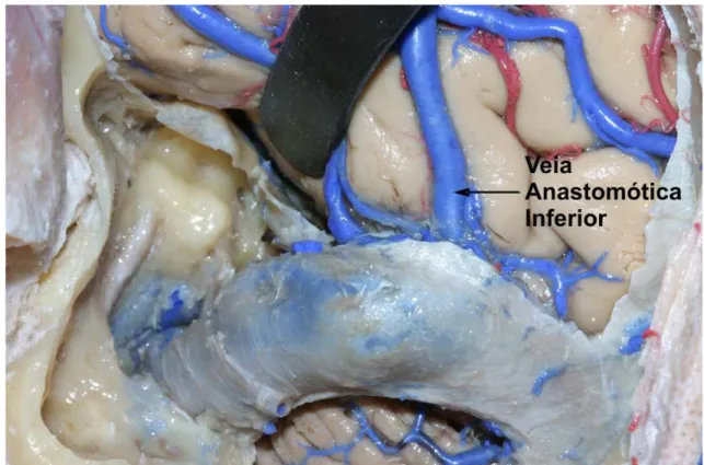 Figura 14. Terminação da veia anastomótica inferior e o acesso pré-sigmóideo. Quanto maior a distância 