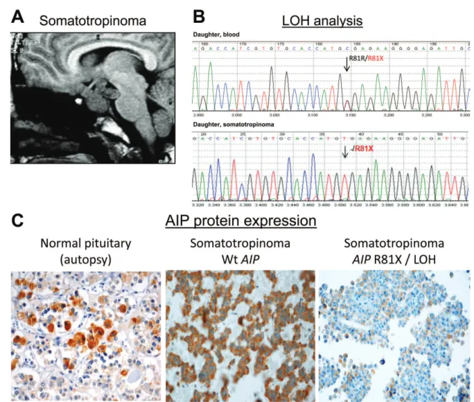 Figure 2 - Loss of AIP in the familial somatotropinoma. A - The MRI of the index patient’s daughter revealed a large and invasive pituitary adenoma (so- (so-matotropinoma) that was resistant to treatment with a somatostatin analog