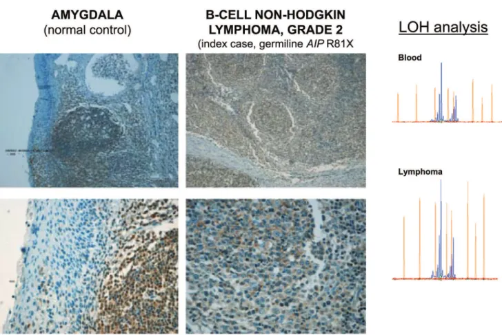 Figure 4 - Maintenance of heterozygosity and positive AIP immunostaining in the B-cell non-Hodgkin lymphoma of the R81X AIP mutated IFS patient.