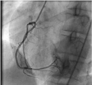 Figure 1 - Left anterior oblique view showing a double right coronary artery.