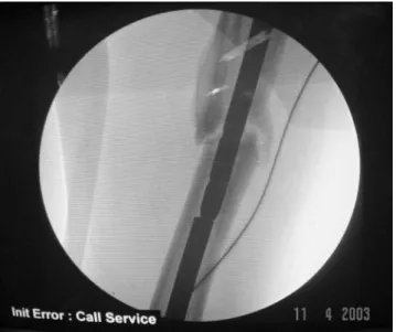 Figure 1 - Intramedullary nail with a diameter that was 2 mm larger than the  fractured nail propelling the distal fragment (luoroscopic view) 