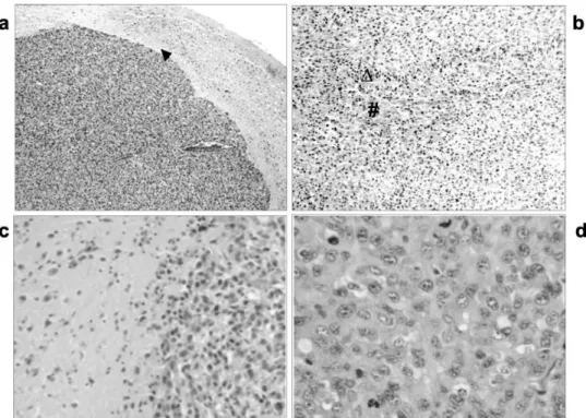 Figure 2 - H&amp;E. Intra-cerebral tumor induced by inoculation of U87MG cells in Provett rats