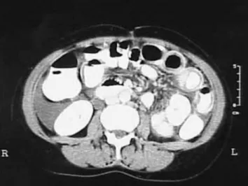 Figure 1 - Abdominal computerized tomography showing dilated bowel,  focal or diffuse bowel wall thickening, and abnormal bowel wall  enhance-ment (a double halo or target sign).