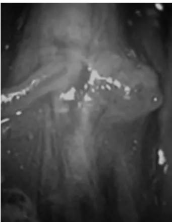 Figure 2 - The wide-base saccular lesion was located adjacent to the aortic  bifurcation.