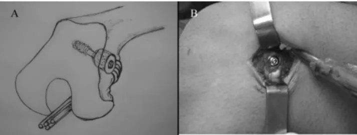 Figure 5 - Image of the screw in the bone one year after surgery.