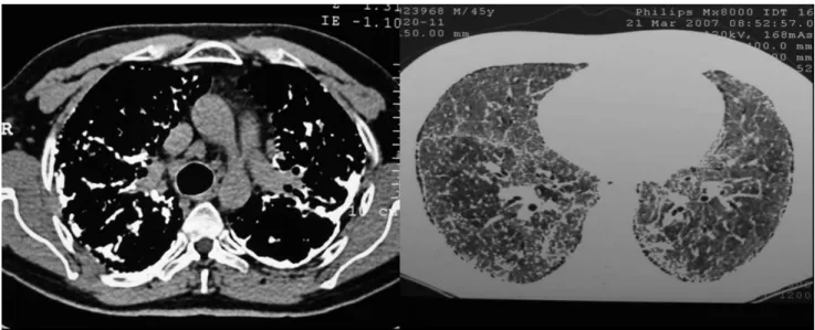 Figure 1 - CT scan showing pleural thickening with calciication and multiples nodules diffusely distributed over the lung parenchyma
