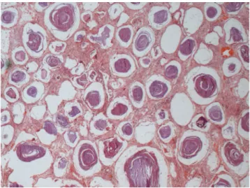 Figure  3  -  Hystologic  specimen  from  the  explanted  lung  demonstrat- demonstrat-ing  the  pulmonary  histological  structure  diffusely  altered  due  to  alveoli  illed by multiples microliths