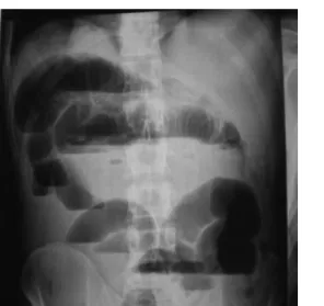 Figure 1 - X-ray ilms showing multiple air-luid levels