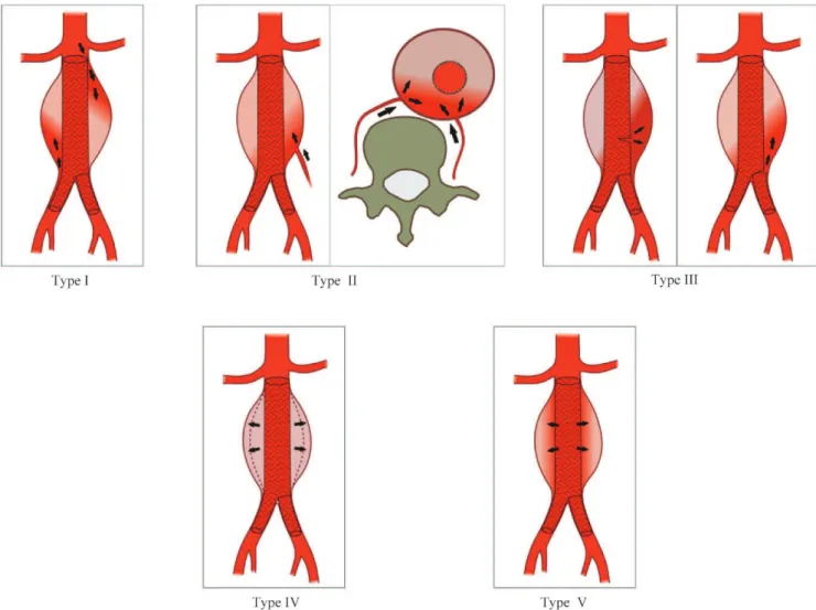 Figure 1 - Illustration of endoleaks using the Veith classification (Veith et al. 4 ).