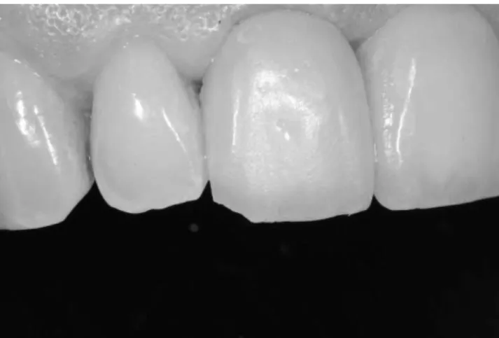Figure 3 - Poor gingival response at the 1-year follow-up.