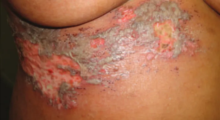 Figure 1 - Grouped erythematous vesiculous and crusted herpes zoster lesions on the right thoracic region along the intercostal nerve path.