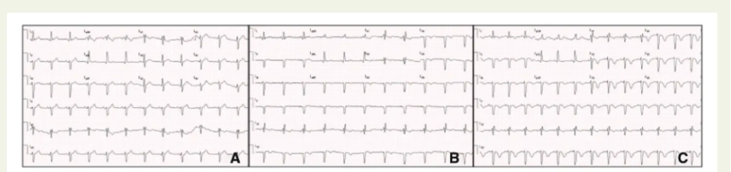 Figure 1 Electrocardiograms showing loss of R wave progression and T wave inversions in the anterior leads