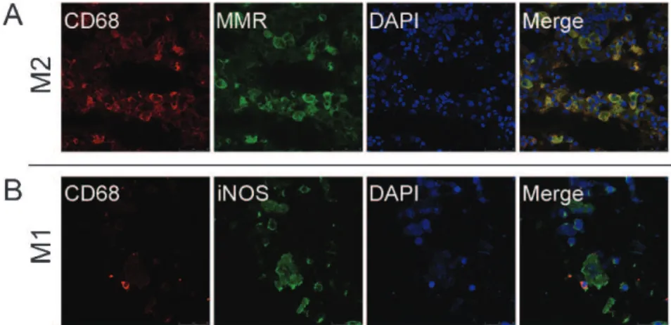 Table 1 also depicts the correlations between TAMs, M1- M1-or M2-polarized TAMs and clinicopathologic features