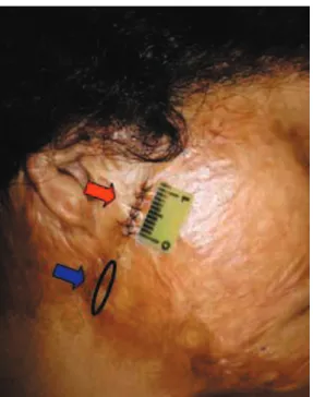 Figure 1 - Pre-treatment biopsy (superior arrow) and planning for the post-treatment biopsy (inferior arrow).