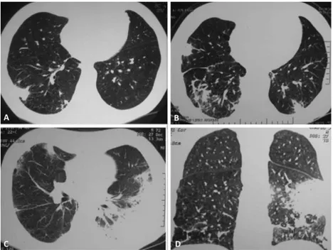 Figure 2 - Chest CT scans obtained in 2009. On the left column, solitary pulmonary nodule in the upper right lobe along with parenchimal bands in the inferior right lobe