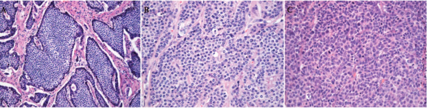 Figure 1 - A) A G1 neuroendocrine tumor (hematoxylin-eosin, X200). Note the uniformity and the characteristic organoid growth pattern