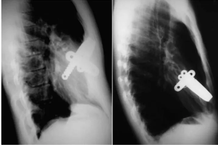 Table 1 - Minor and major complications observed in the three series. Complication First series(n= 24) Second series(n= 47) Third series(n= 51) Pneumothorax 1 (4.1%) 1 (2.1%) 0 Suture infection 2 (8.3%) 0 0 Pleural effusion 0 1 (2.1%) 0