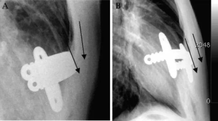 Figure 5 - A) One stabilizer, with two different, non-parallel planes between the bar and internal surface of the sternum