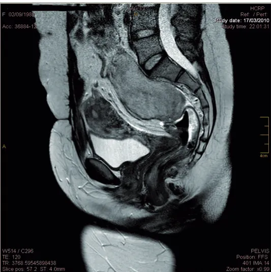 Figure 2 - Magnetic resonance imaging (MRI) showing another mass in the region anterior to the sacrum.