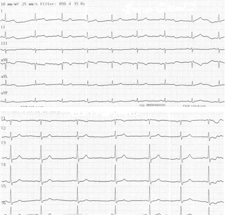 Figure 2 - Normal sinus rhythm 6 hours after admission.
