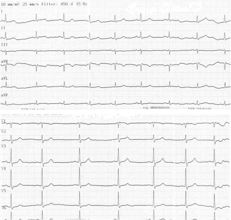 Figure 2 - Normal sinus rhythm 6 hours after admission.