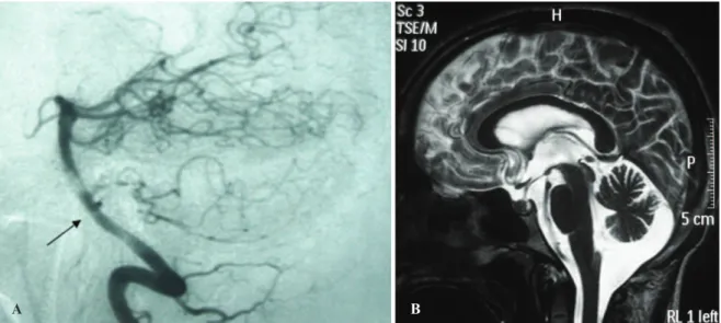 Figure 1 - A) Cerebral angiography at admission revealed a small saccular aneurysm of the basilar artery near the emergence of the anterior inferior cerebellar artery (AICA)